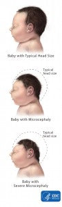 microcephaly-comparison - via CDC