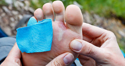 Natural Treatments for Blisters and Itching